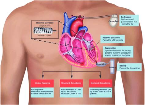 Medtronic LV pacing 